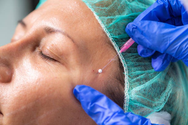 The Future of Facial Rejuvenation: Thread Lift in Riyadh