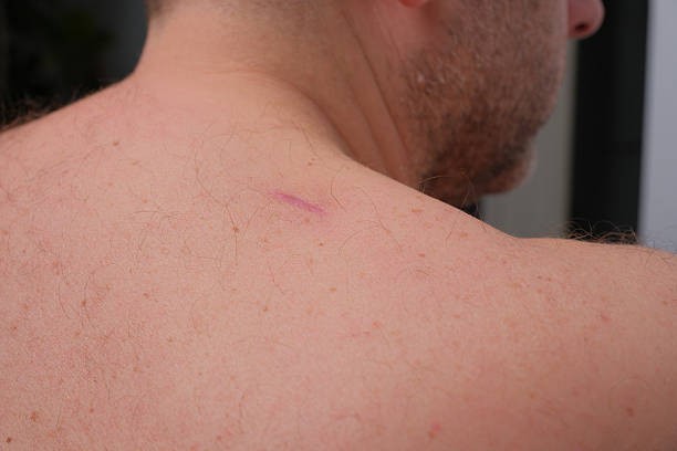 Laser Scar Removal for Improving the Look of Surgical Scars