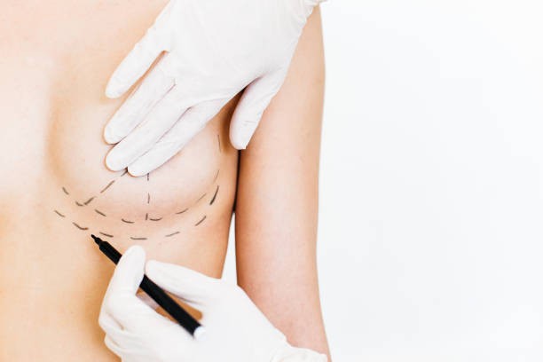 Breast Surgery Insights for Achieving Refined Natural Results