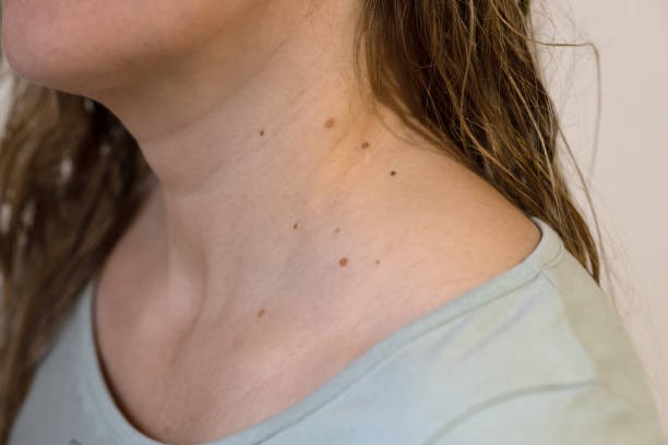 Skin Tag Removal for Managing Unwanted Skin Growths
