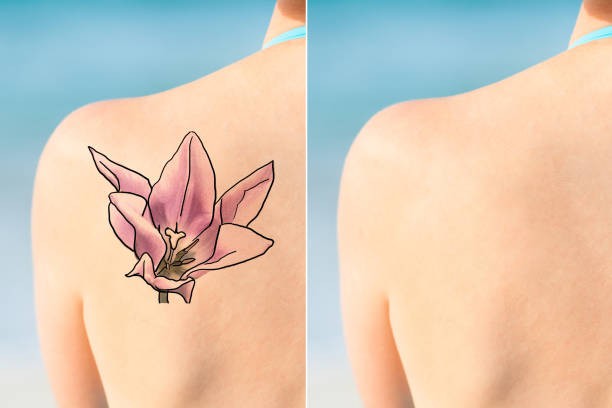 Important Considerations When Planning Laser Tattoo Removal