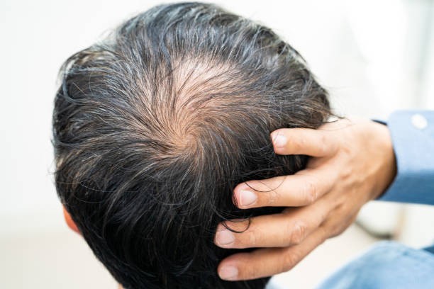 Hair Loss Treatment for Improving Overall Hair Fullness and Resilience