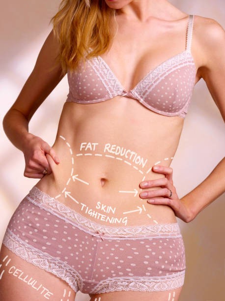 Liposuction for Improving the Definition of Specific Body Areas