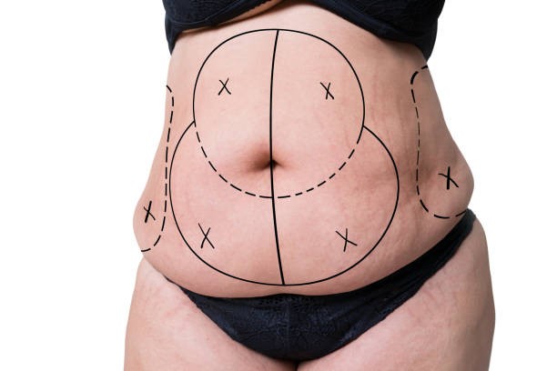 Tummy Tuck Surgery and Its Impact on Abdominal Body Proportions